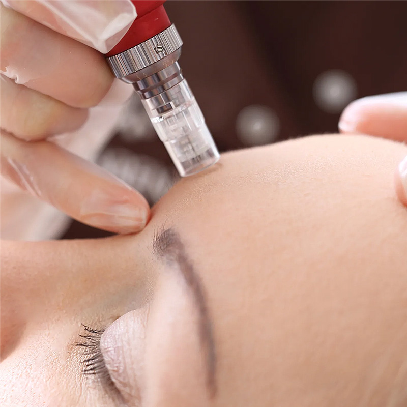 Microneedling Services at Bloom Skin & Beauty Shoppe