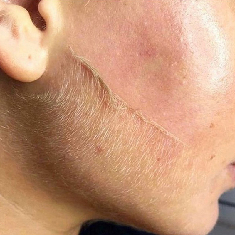 Remove peach fuzz on shop face